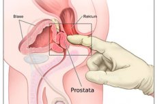 masaz prostaty